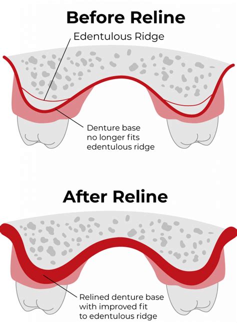 Denture Reline Que Es