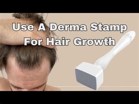 Derma Stamp Technique for Beard Growth