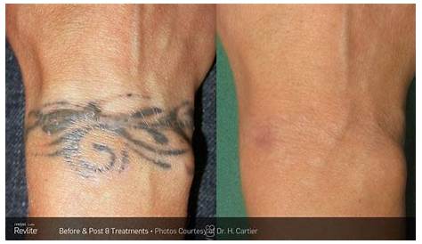 Why Tattoo Removal? TattooRemovers.ink