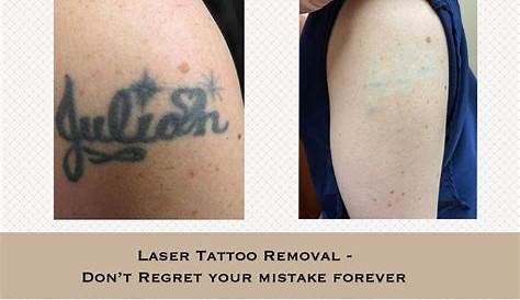 Dermabrasion Tattoo Removal Pictures