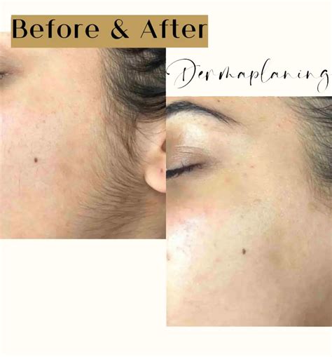 Dermaplaning Facial Edmonton