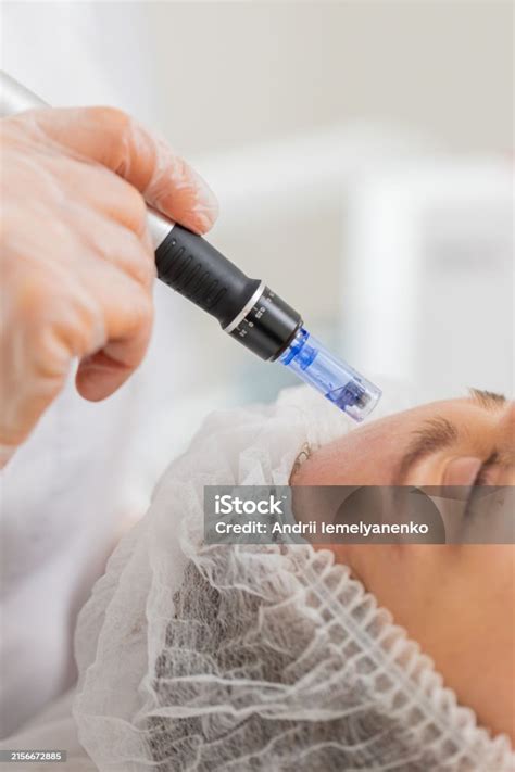 Derma Stamp Procedure