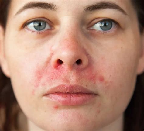 Dermatitis Around Nose And Eyebrows