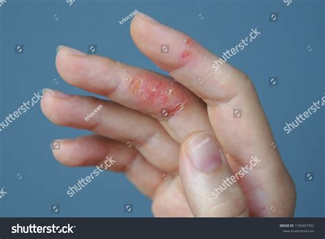 Understanding and Managing Dermatitis on Fingers: Causes and Relief