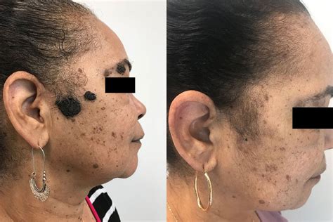 dermatologist mole removal near me