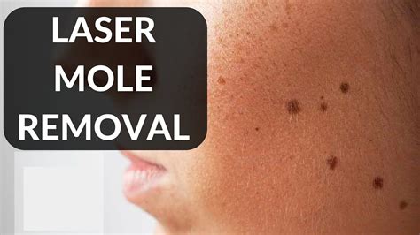 dermatologist mole removal near me reviews
