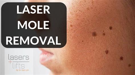 dermatologist that remove moles near me