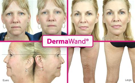 dermawand before and after