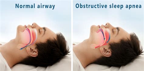 desaturation model of sleep apnea