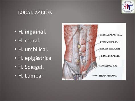 descrição de hernia inguinal