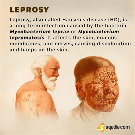 description of leprosy in the bible