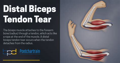 Understanding and Treating a Detached Bicep Tendon Injury Effectively