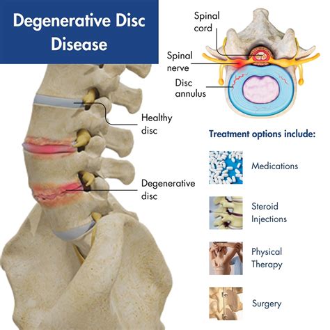 Deteriorating Spinal Discs