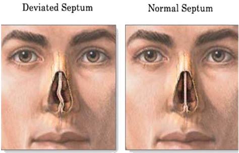 Correcting a Deviated Nasal Septum: Surgery Explained Clearly