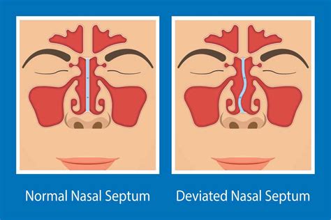 Deviated Septum Covered By Insurance / Fractured Nose Septum Surgery