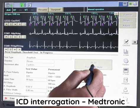 Device Interrogation Icd 10