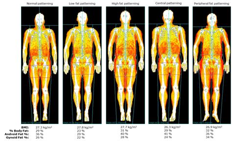 DEXA Scan Body Fat All About Dexa Body Fat AQ Modern Imaging