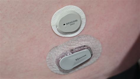 dexcom g 7 patch