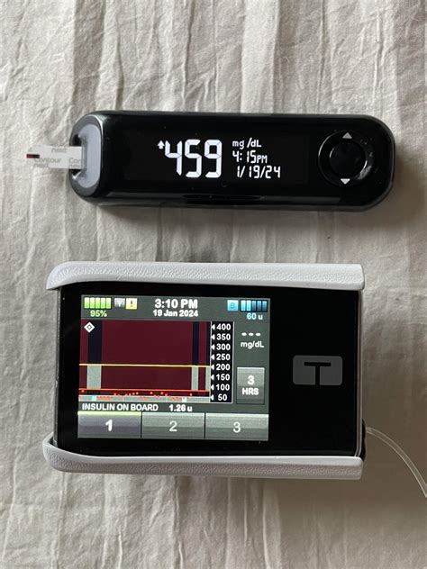 What is a CGM compression low? Why does it happen? This T1D Parent