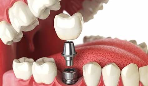 Diş Implant Enfeksiyonu