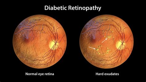 Protect Your Vision: The Importance of Diabetic Eye Exam