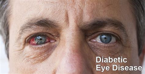 diabetic vision problems treatment