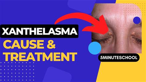Diagnosing Xanthelasma