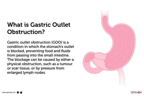 Gastric Outlet Obstruction Anesthesia Key