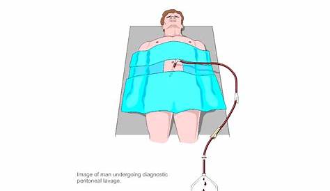 Diagnostic Peritoneal Lavage Procedure s Anesthesia Key