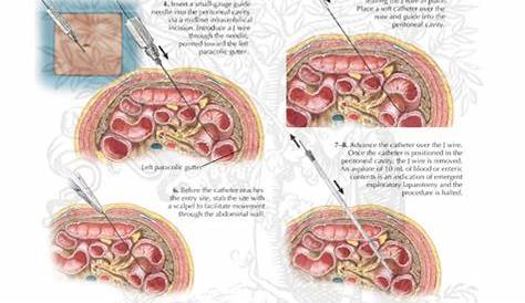 Diagnostic peritoneal lavage procedure diagram