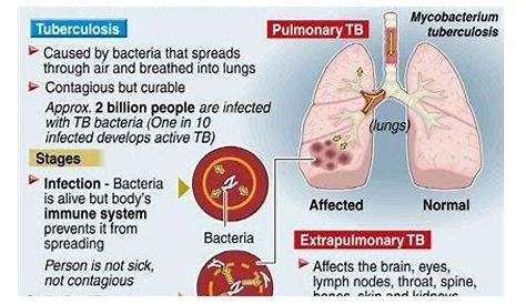 Diagnostic Test For Tb In The Philippines OnSite TB IgG/IgM Combo Rapid IVC s