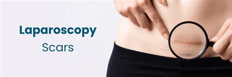 Diagnostic Laparoscopy Scars