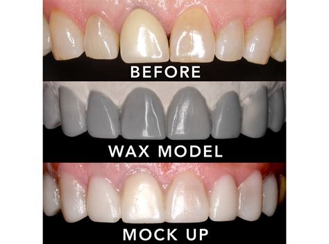 Diagnostic Wax Up Worn Teeth