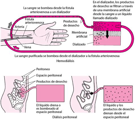 dialisis