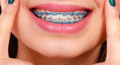 Diamond Braces Contact
