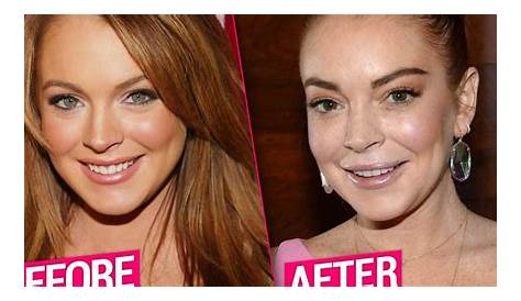 Unveiling The Truth: Lindsay Lohan's Cosmetic Surgery Journey
