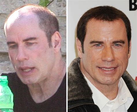 did john travolta have a hair transplant