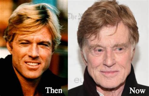 did robert redford have a leg removed