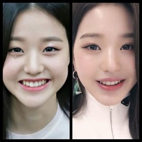 did wonyoung get plastic surgery