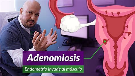 diferencia entre adenomiosis y endometriosis