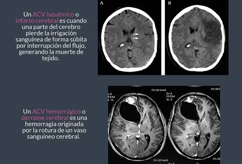 diferencia entre infarto e ictus