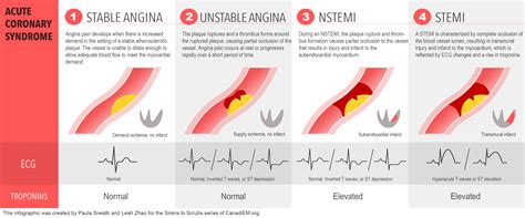 difference between a stemi and nstemi