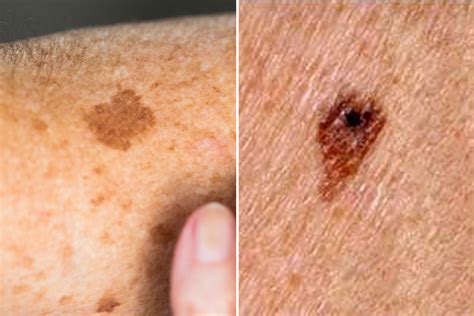 difference between age spot and melanoma