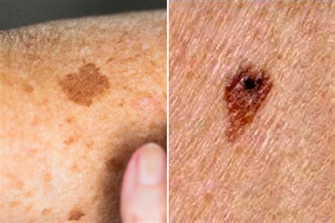 difference between age spots and melanoma