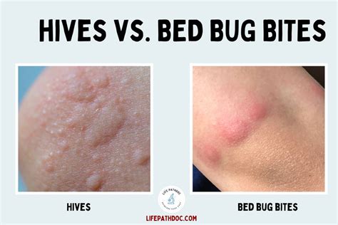 Difference Between Bed Bug Bites And Hives