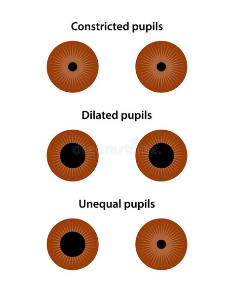 Difference Between Constricted And Dilated Pupils