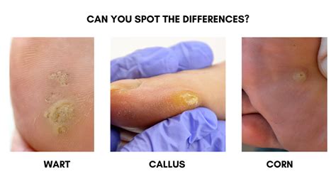 Difference Between Corn Callus And Wart