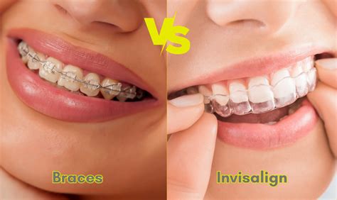 Difference Between Invisalign And Fixed Braces