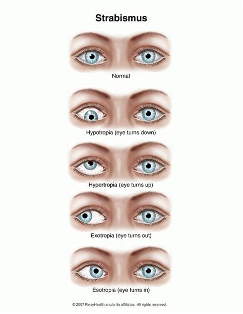difference between strabismus and exotropia