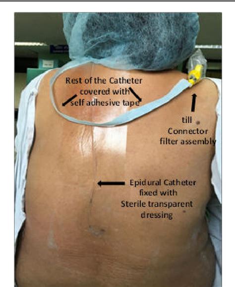 Different Epidural Catheters